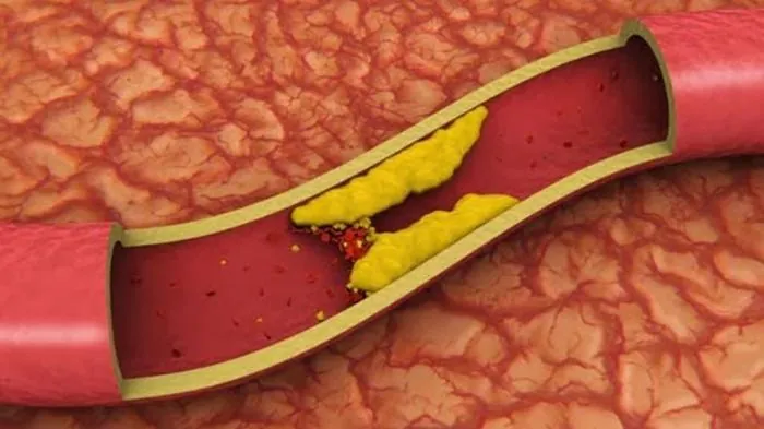 apa itu kolesterol di pembuluh darah